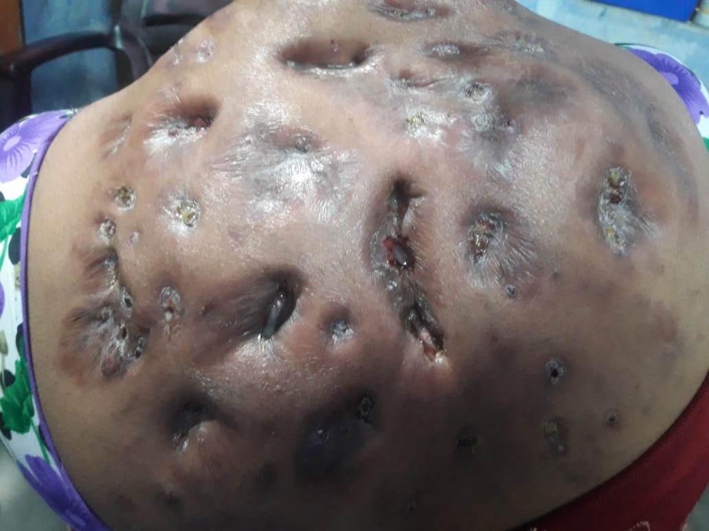 Chronic Recurrent Abscess