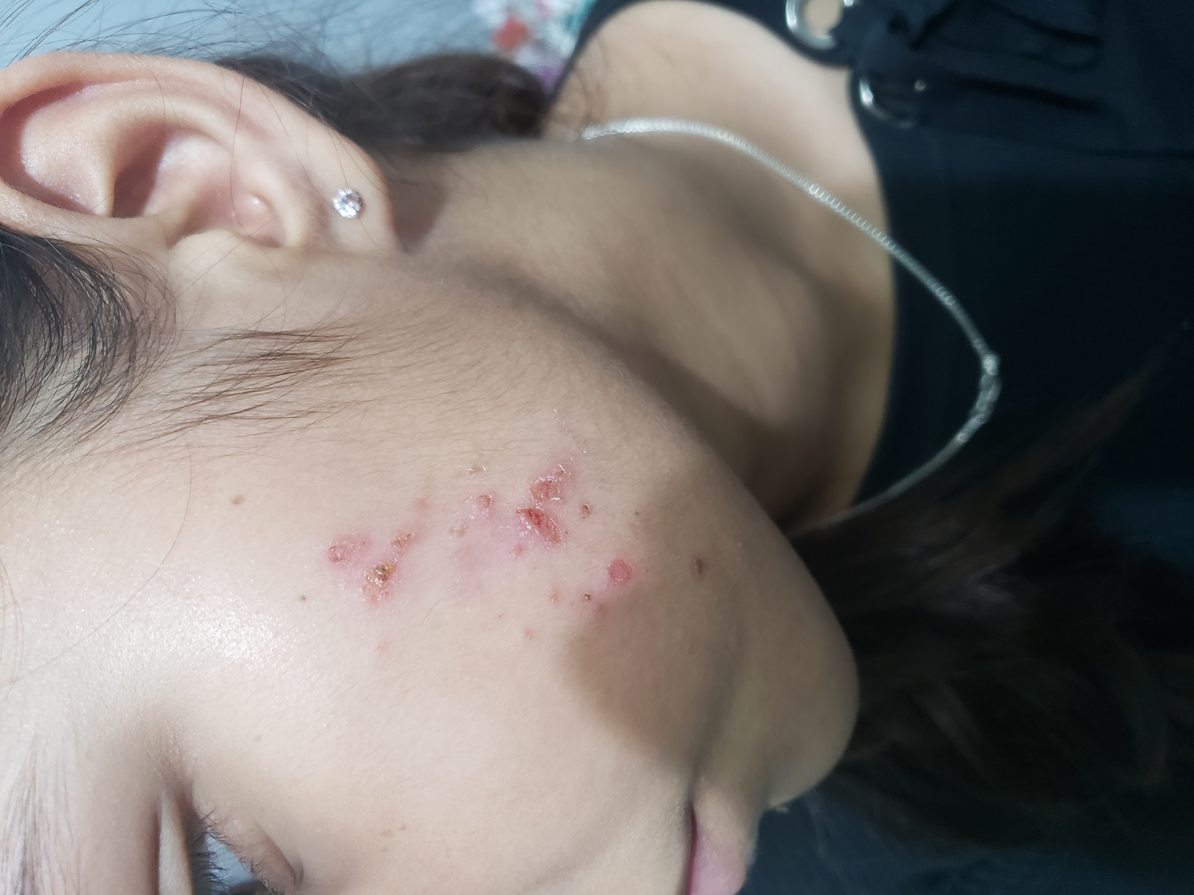 Is It Due To Insect Bite?