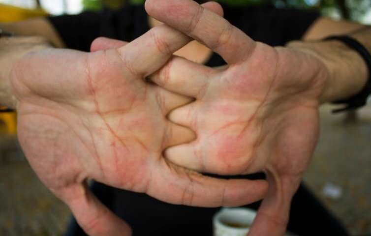 What Makes Joints Pop And Crack And Is It A Sign Of Disease?