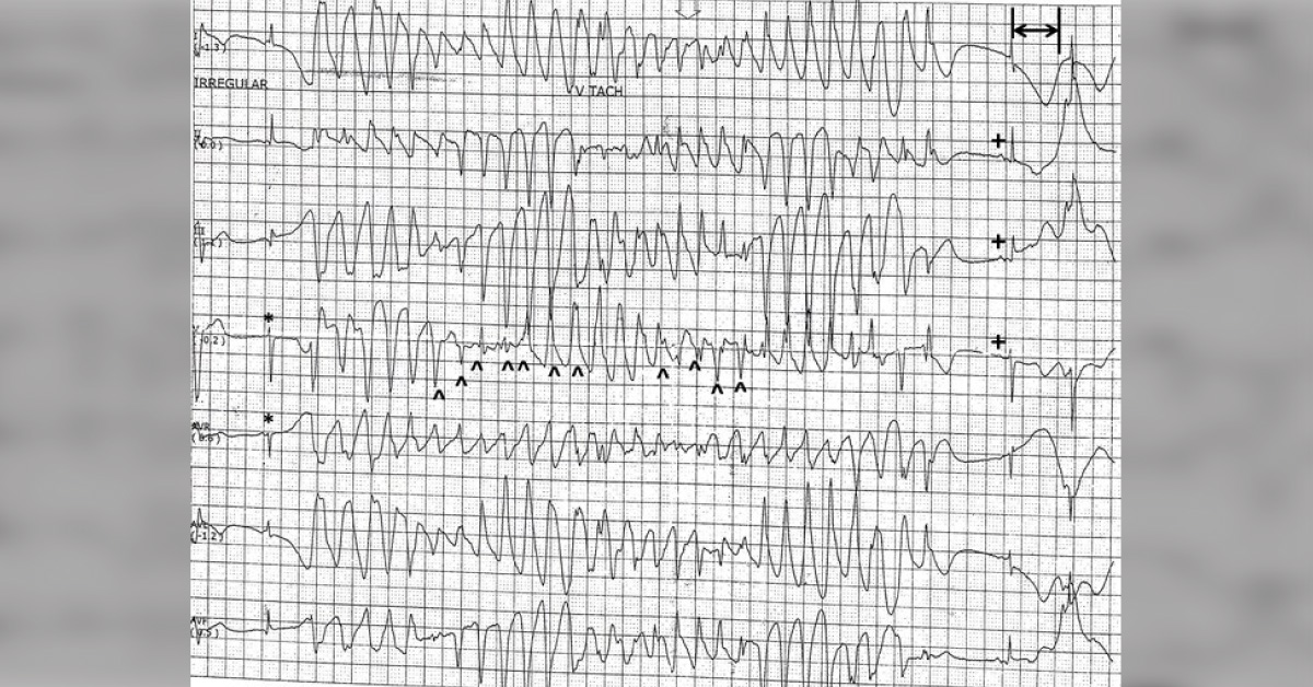 An Adolescent with an Unexplained Seizure