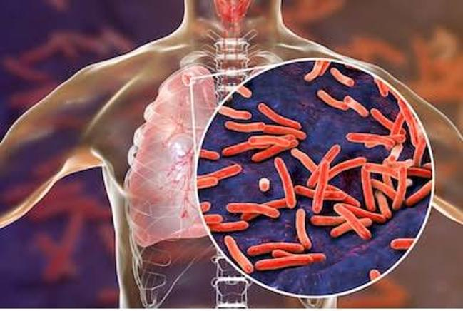 WHO Releases New Guidance On Treating Drug-resistant Tuberculosis In Children And Adolescents