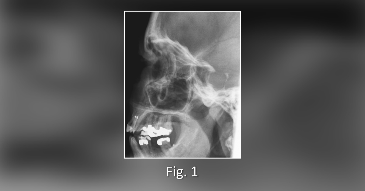 A Patient with a Long History of Nasal Discharge: What can be the Diagnosis?