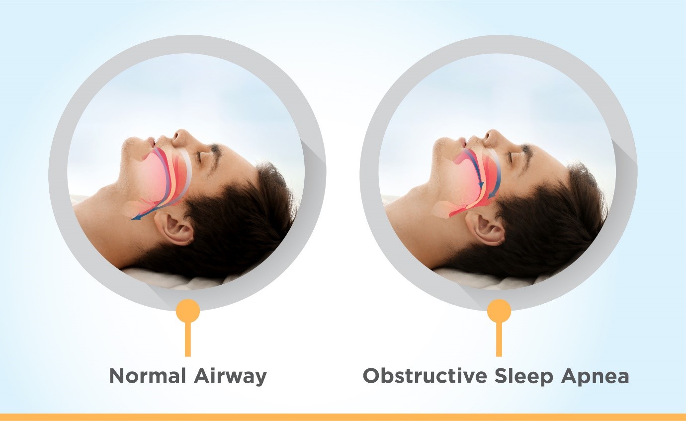 Nasal Congestion And Its Clinical Link With Sleep Apnea
