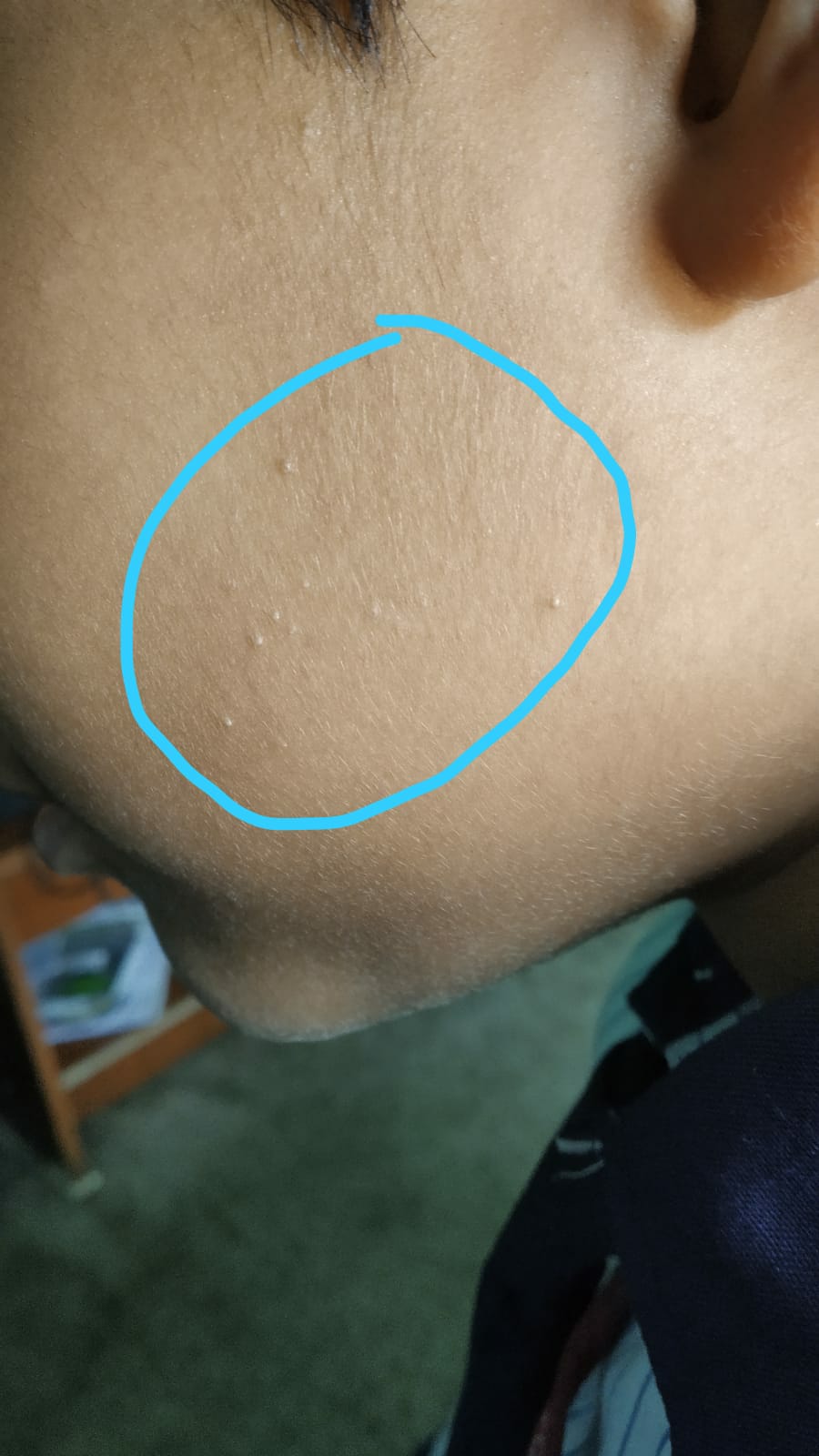 Case Of Skin Papules
