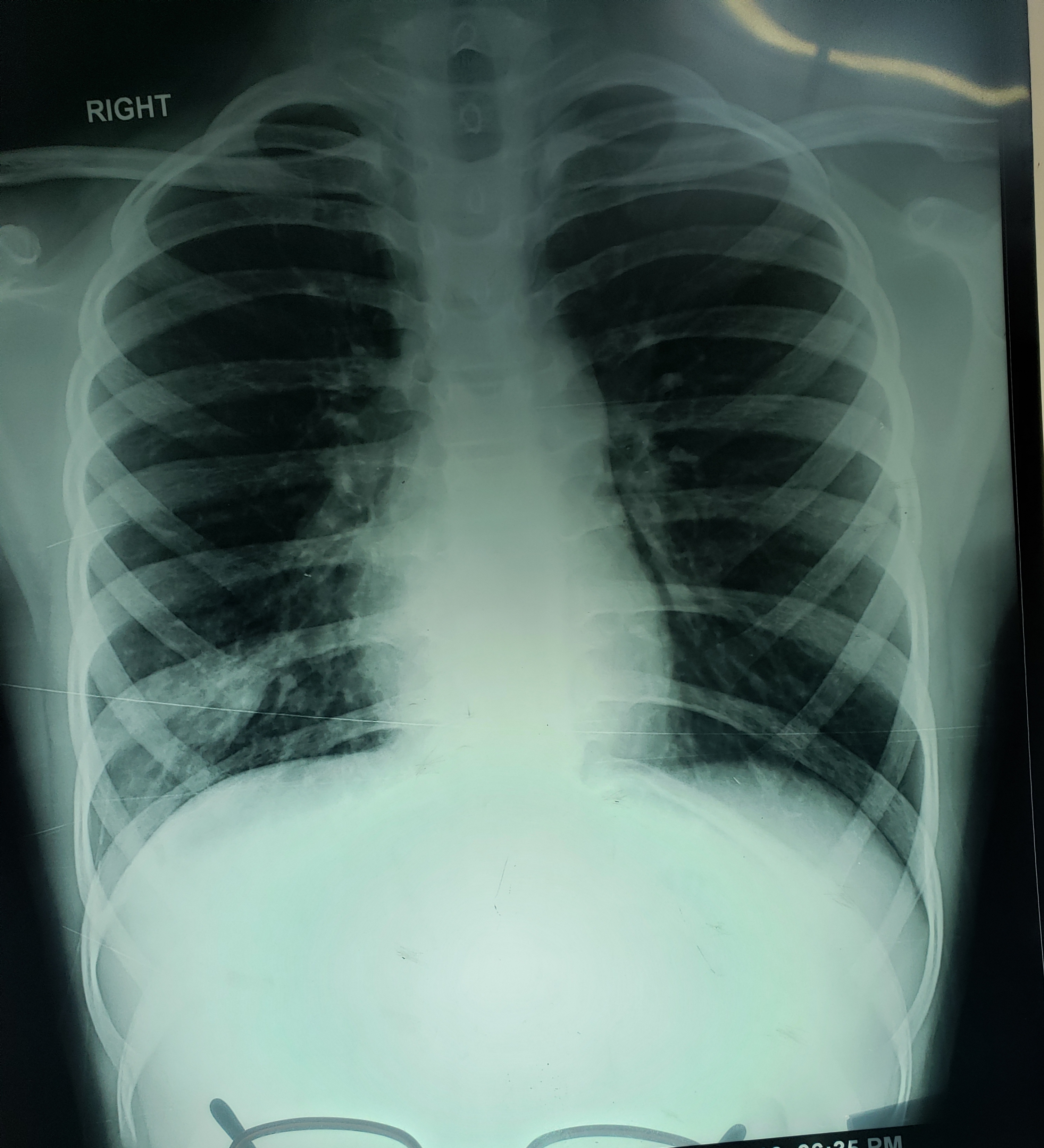 What Is This Peculiar Infection In Rt Lower Lobe?