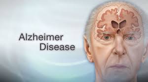 Alzheimer's Disease And Diet