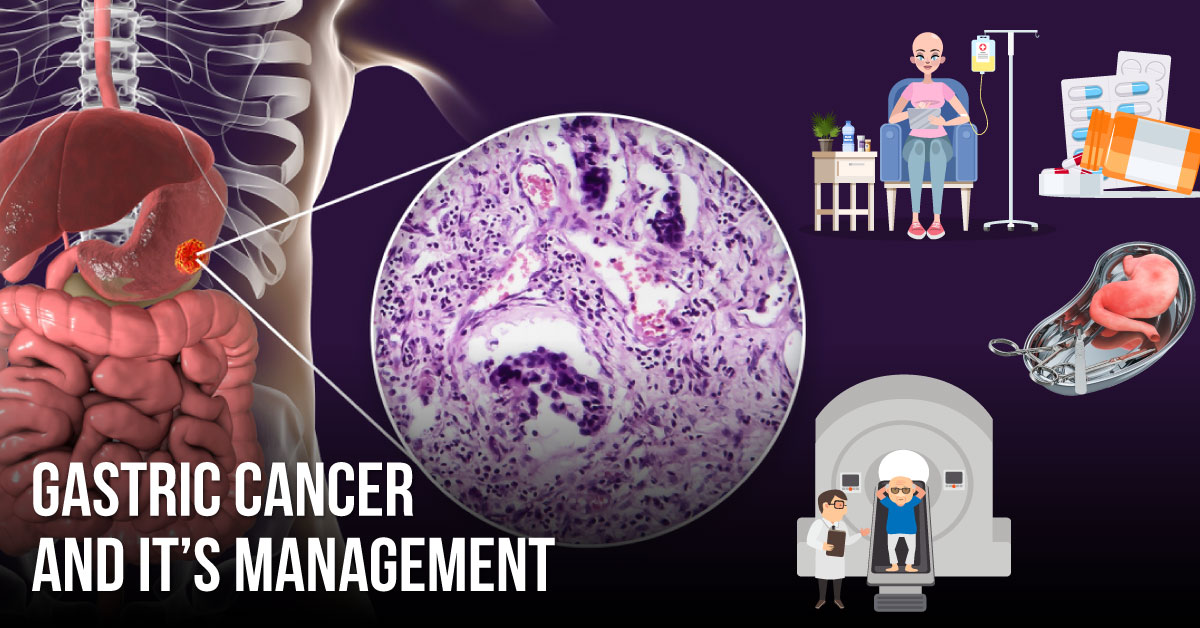 Effective Management Of Gastric Cancer