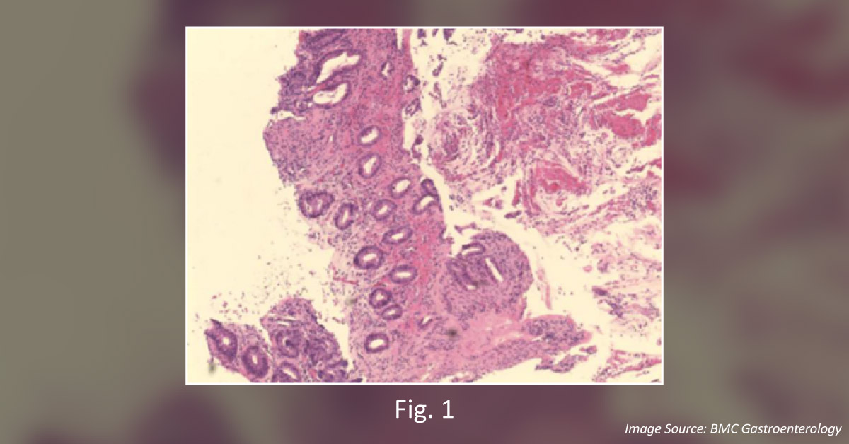 Diagnose This Complication of Bloody Diarrhea
