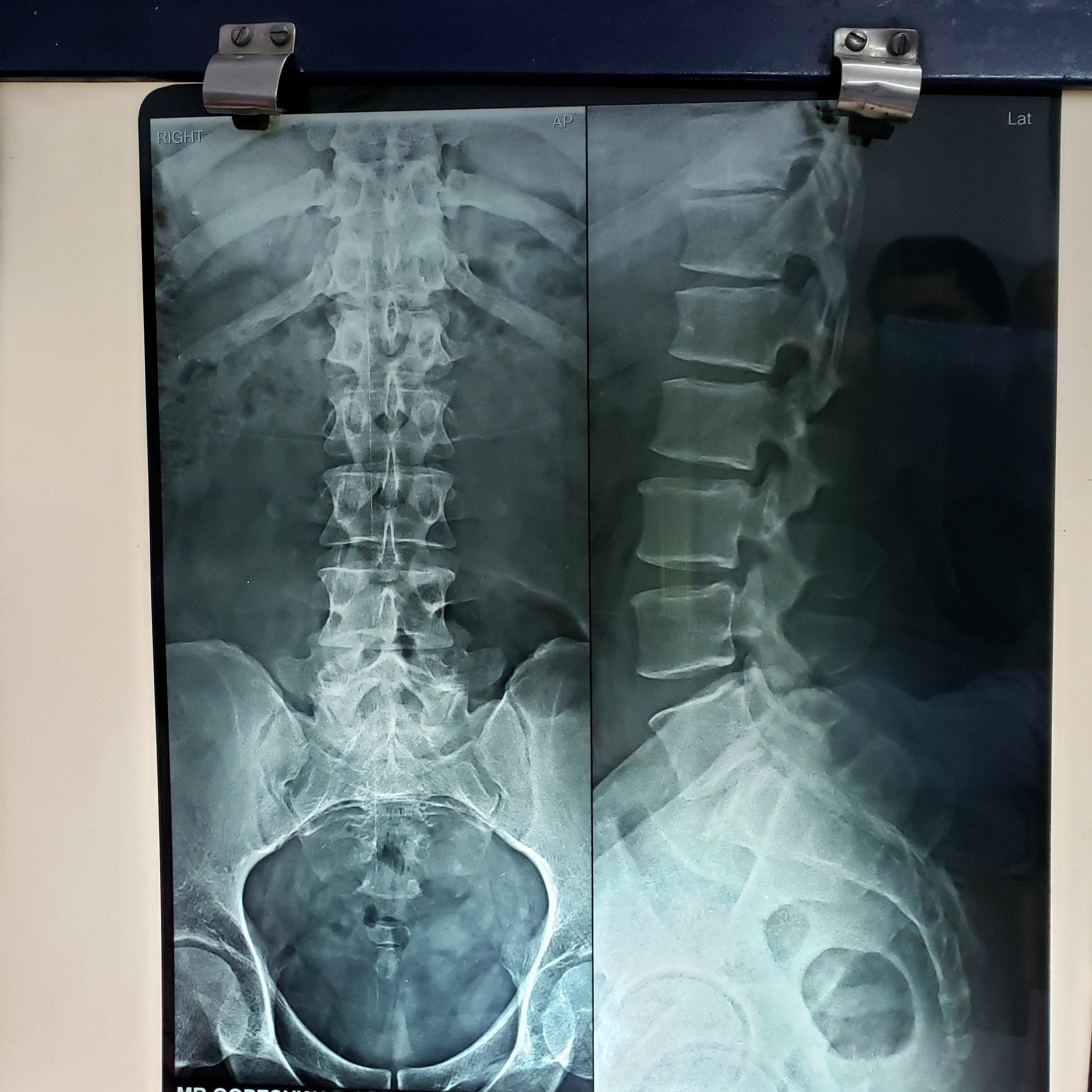 How Many Fractures Are There In This X-ray And Where?