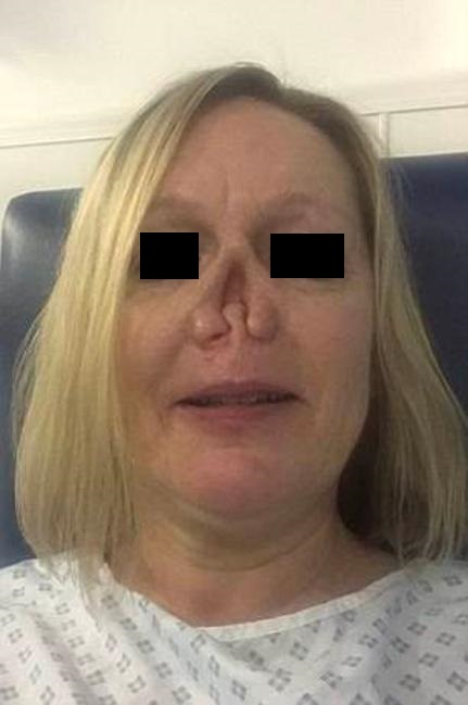 Diagnose The Disease- Outcome Of It Is Surgical Removal Of Nose