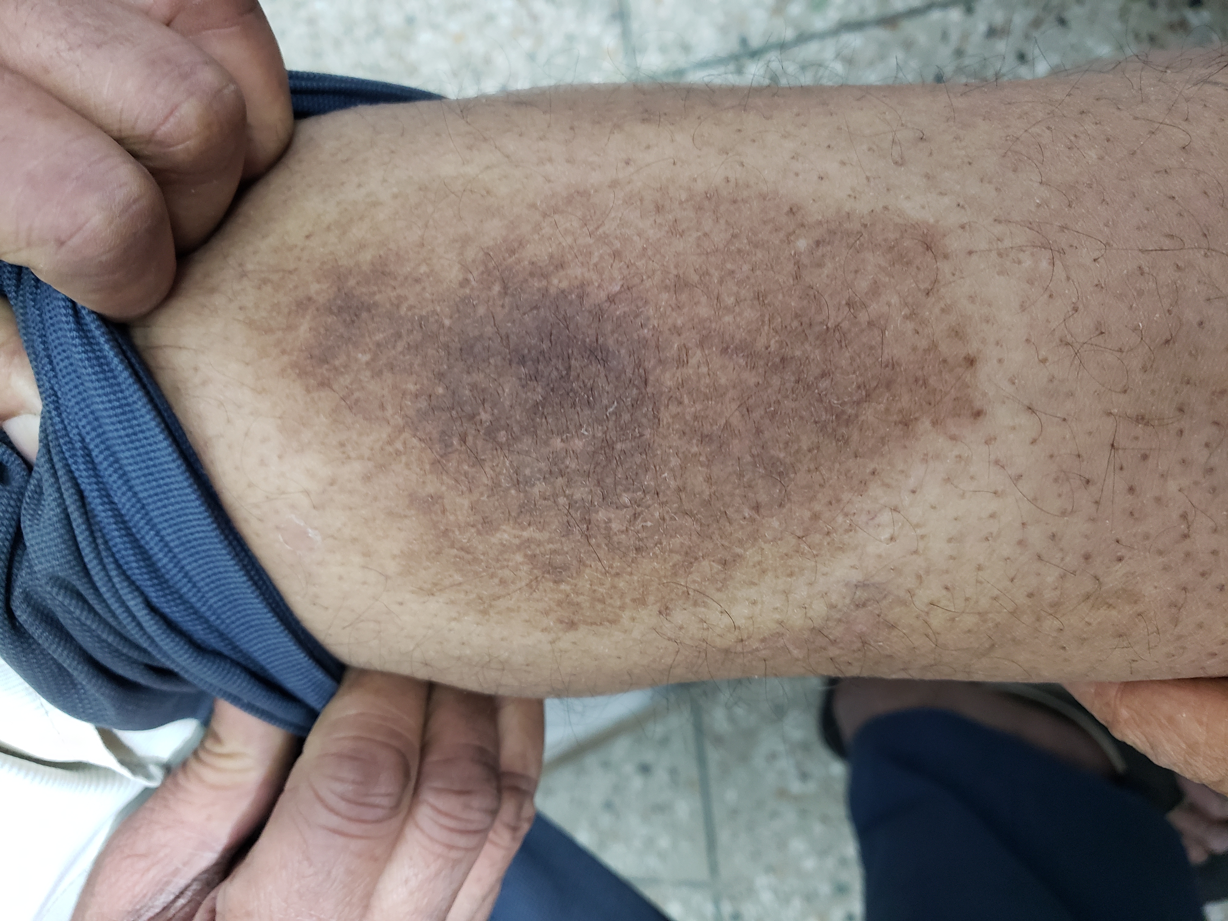 Is This Skin Problem Associated With Ulcerative colitis?