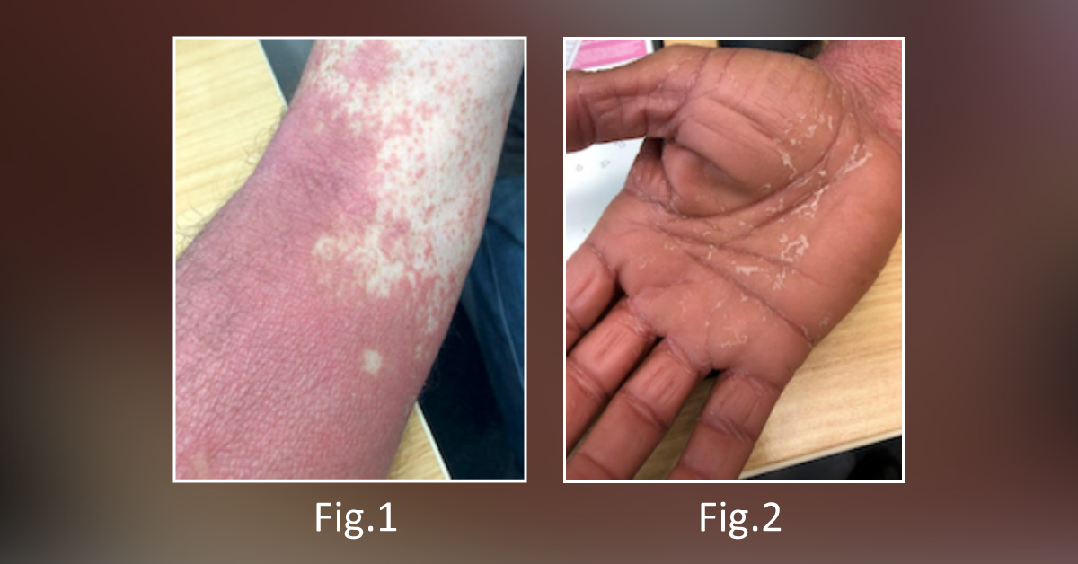 An Elderly Man With A Sudden Onset of Erythroderma