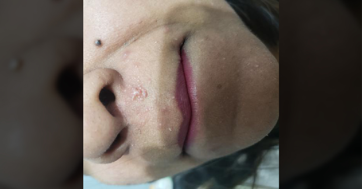 Spot The Diagnosis And Suggest Treatment?