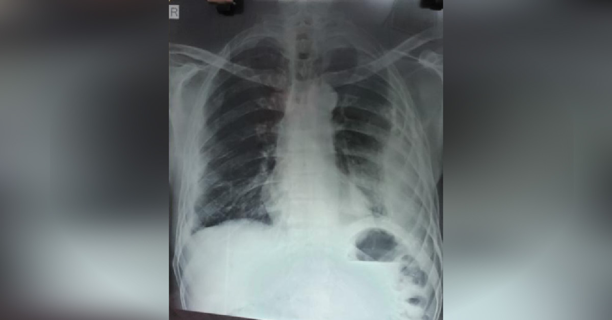 Spot The Diagnosis Of This Xray Chest PA View