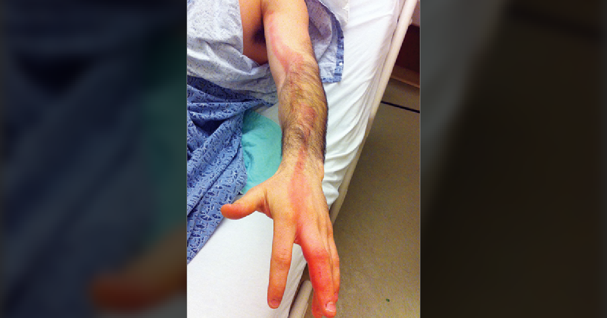 A Case Of Excruciating Arm Pain And Erythema