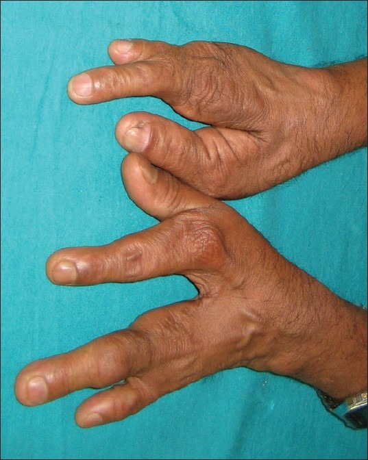 Diagnose This Congenital Deformity.any Associated Disease?