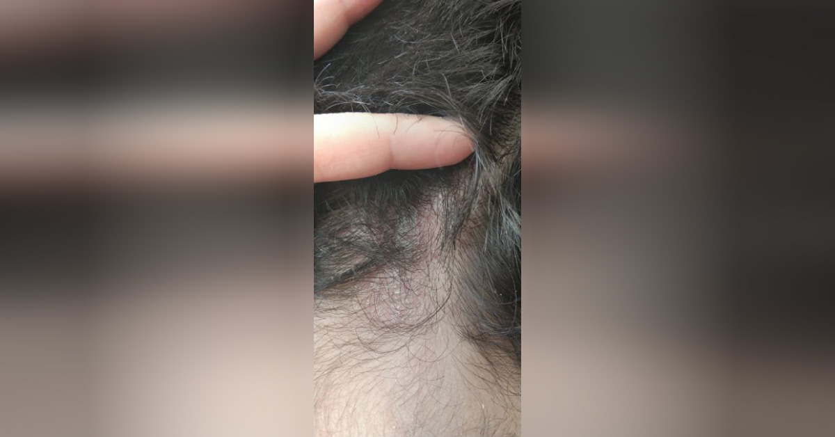 What Are These Lesions On the Scalp?