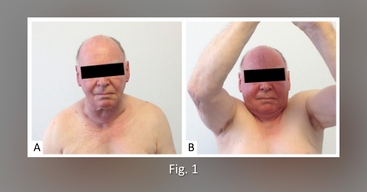 A Geriatric Patient Manifesting Unusual Hyperthyroidism Symptoms