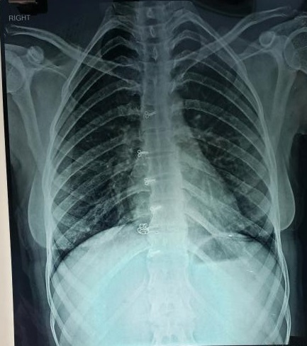 What Is The Cause Of This Shape Of Rib Cage?