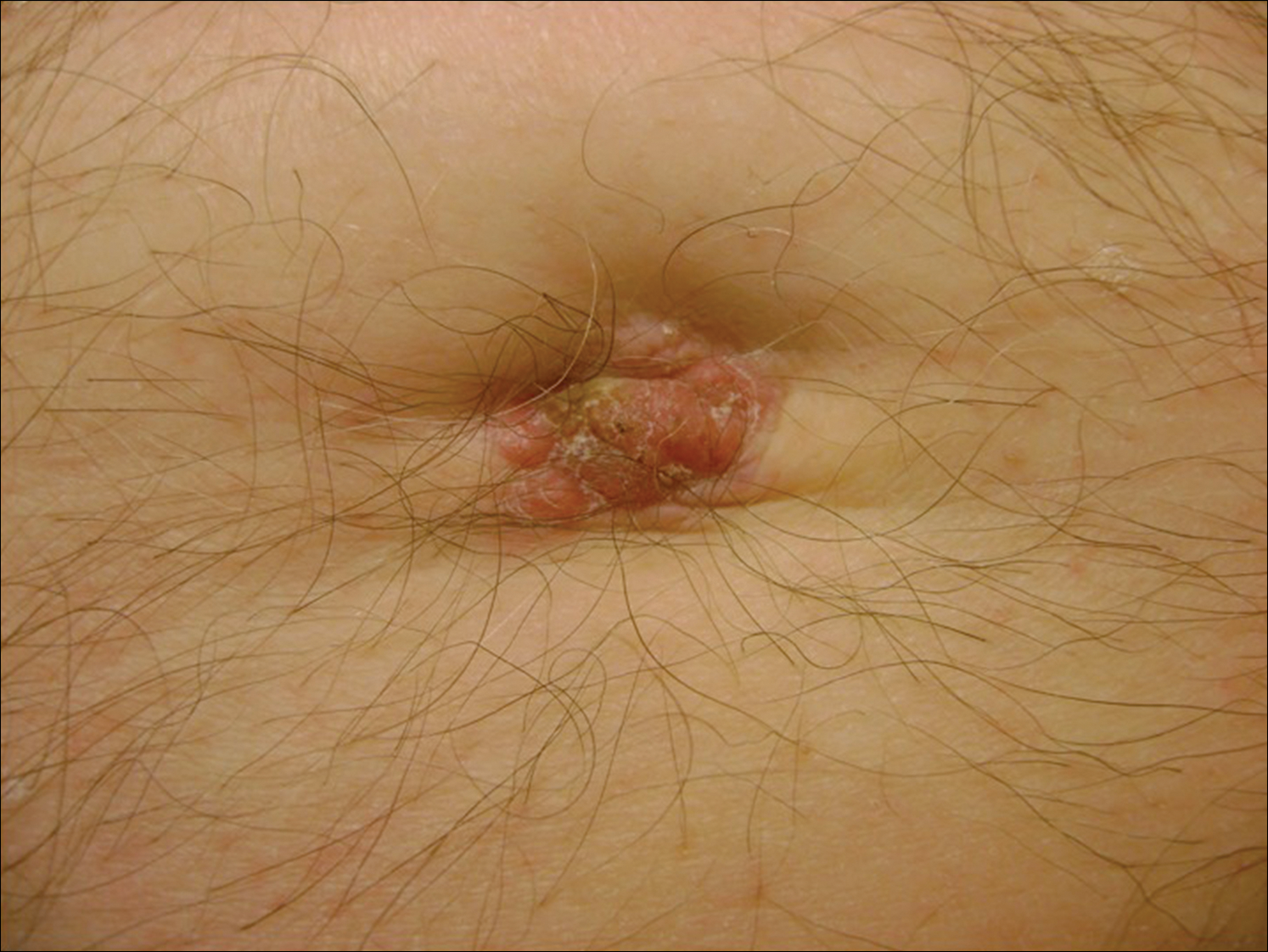 Crusted Plaque In The Umbilicus - What's The Diagnosis?