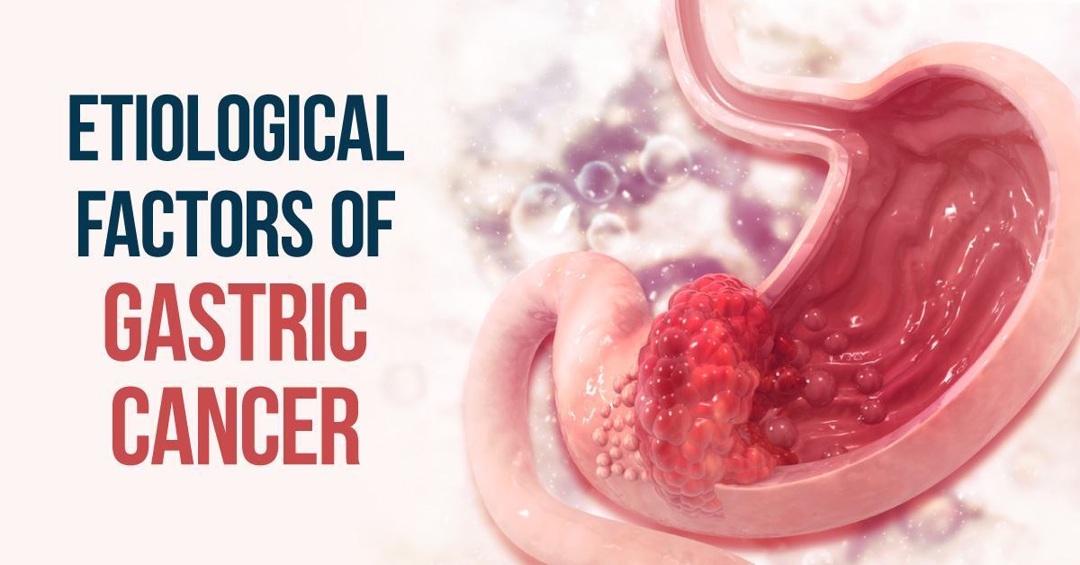 Gastric Cancer: Epidemiology and Etiology