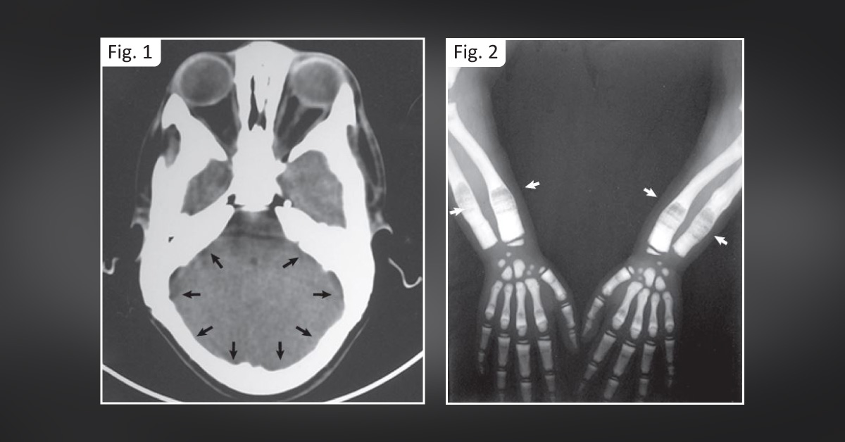 Case of A Rare And Inherited Skeletal Disorder