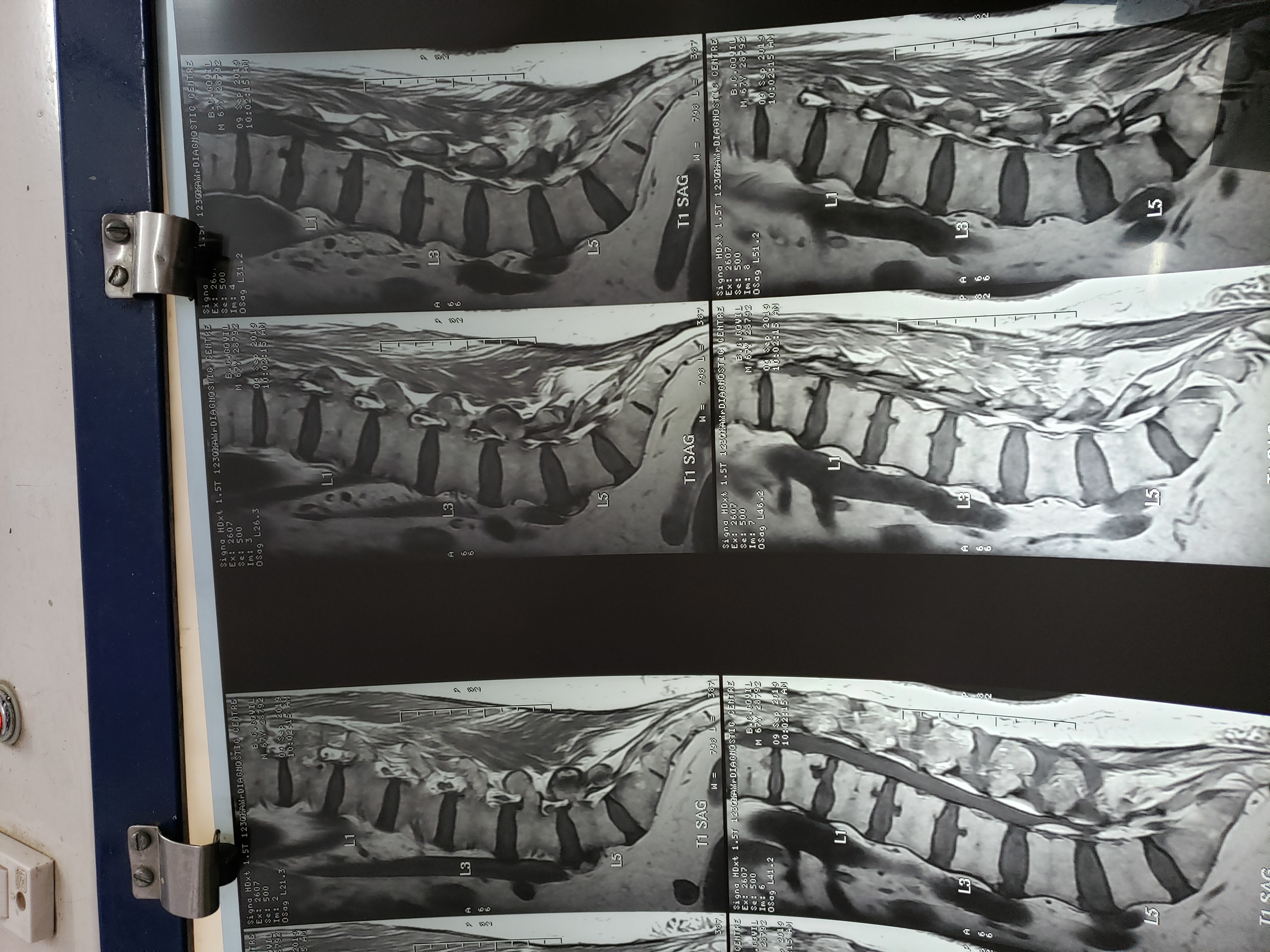 Can Inhalation Of Steroids Cause Upward Herniation Of Inter Vertebral Disc ?