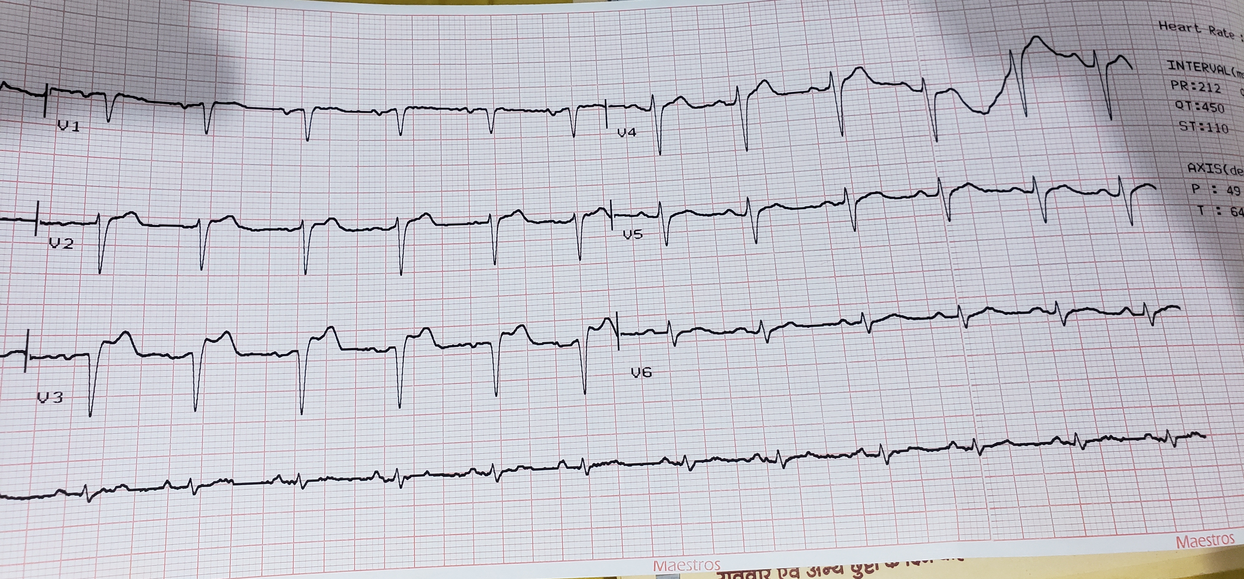 What Is The Diagnosis, In This ECG?