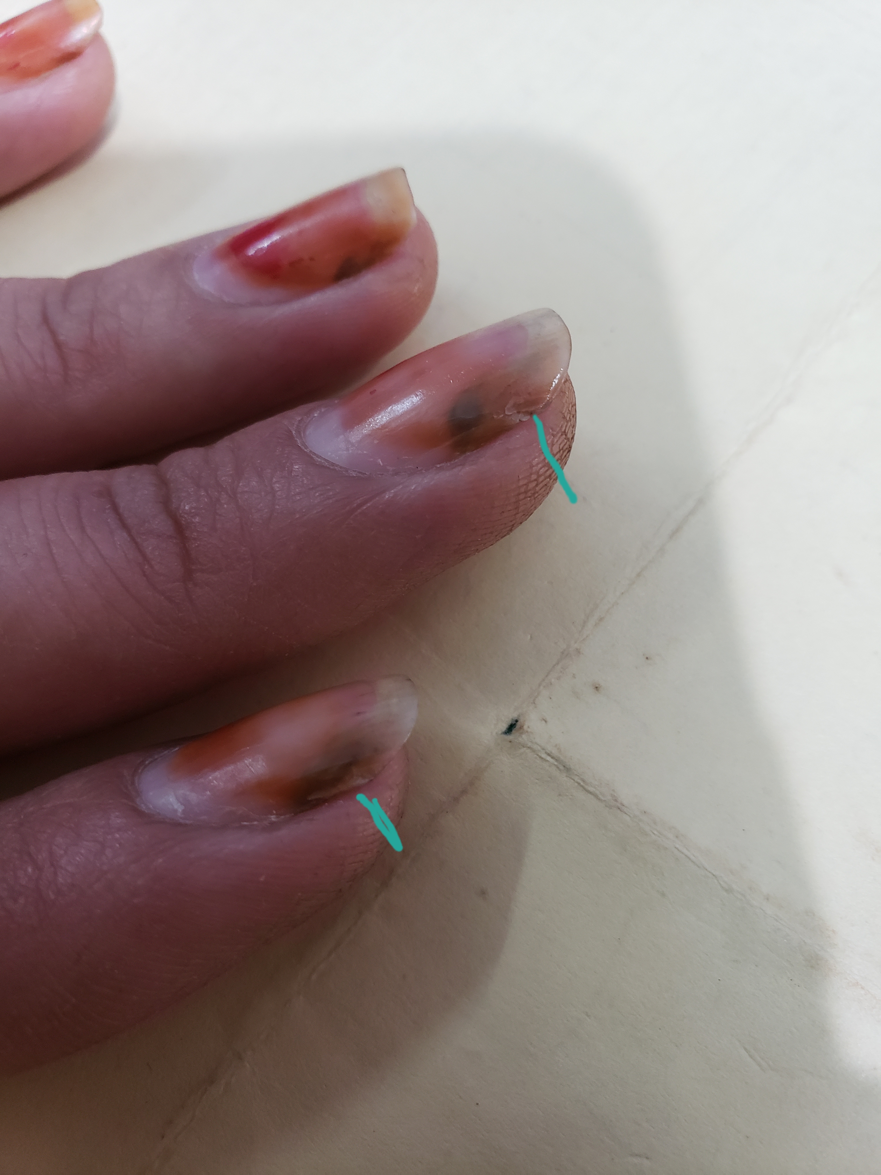 Is This Nail Psoriasis Or Fungal Infection?