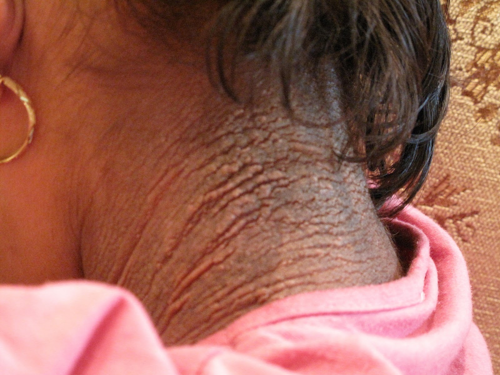 Spot The Diagnosis Of Lesion And Advise Treatment