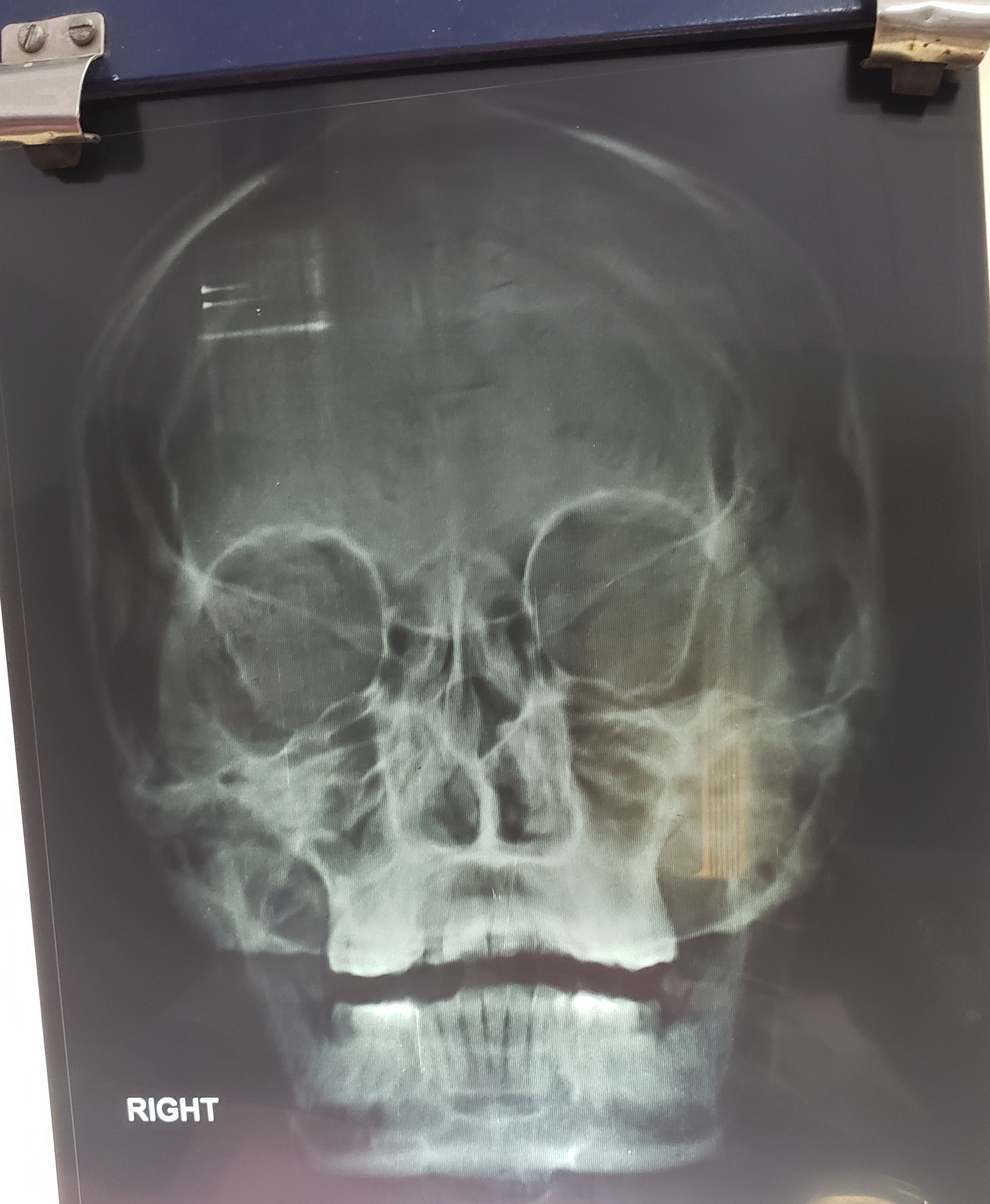 What Are The Abnormal Findings In This X-ray PNS?