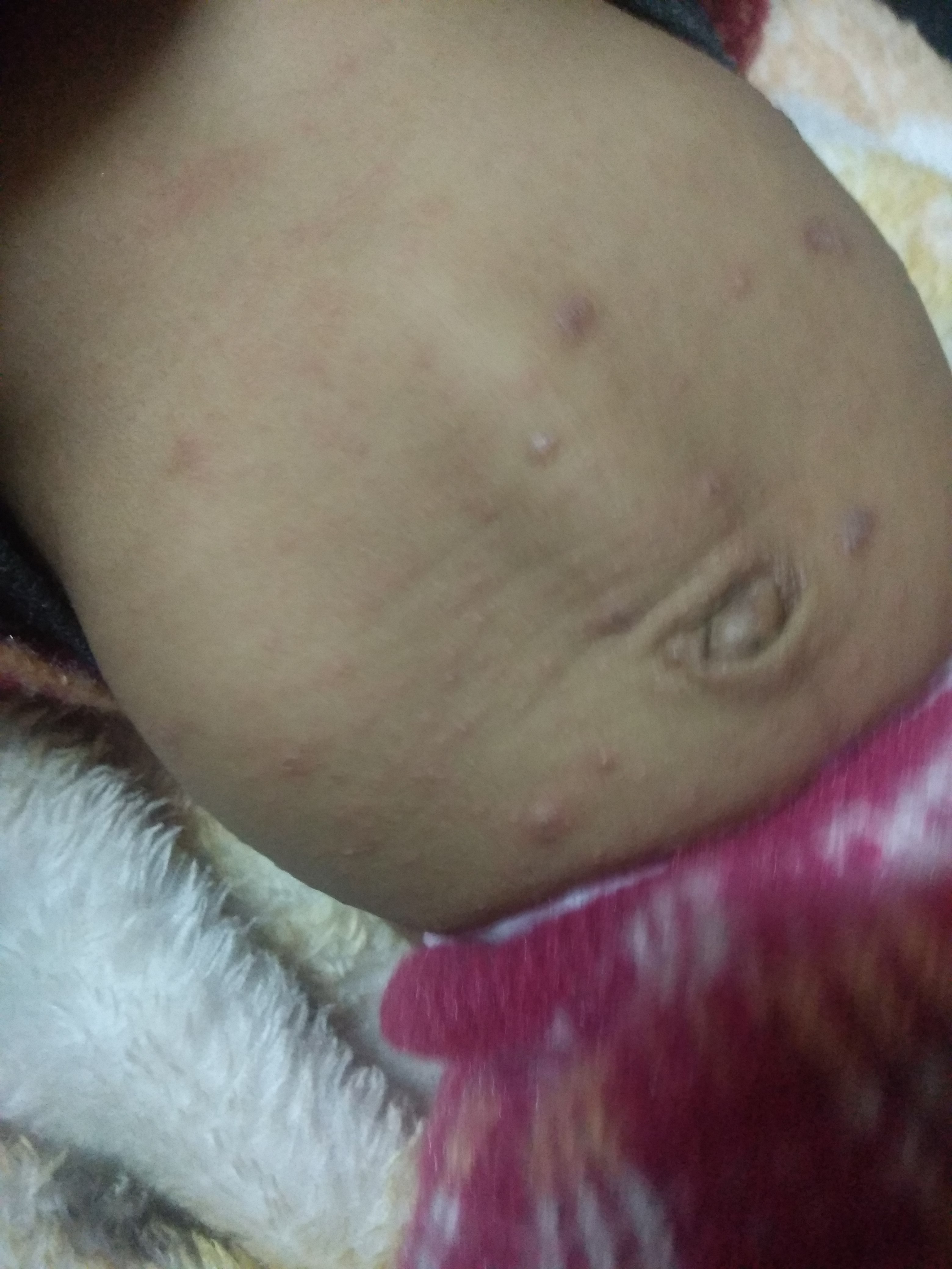 Diagnose The Skin Lesions In 15 Days Baby