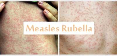 1.4 Lakh People Have Died In Measles Outbreaks: WHO