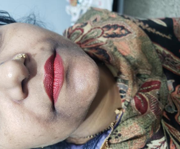 What Is The Type Of Pigmentation Over The Face?
