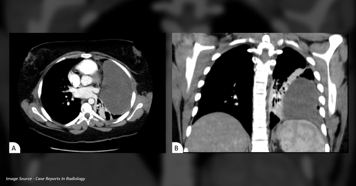 Ace This Case of Recurrent Complex Pleural Effusions
