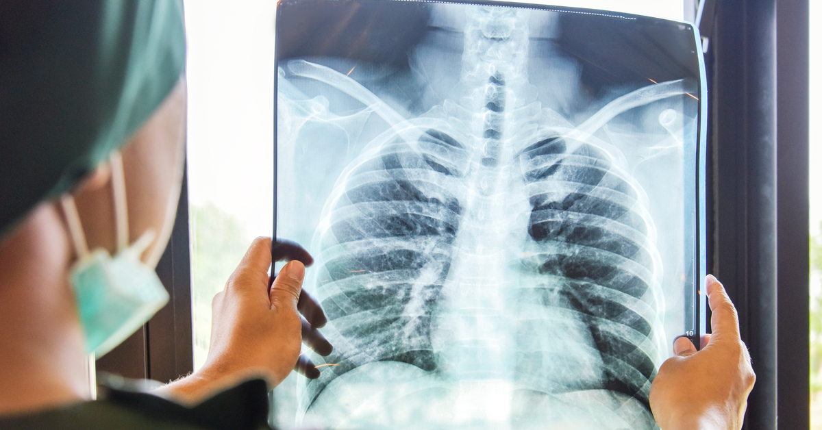 AI May Detect Clinically Meaningful Chest X-Ray Findings At Par With Radiologists