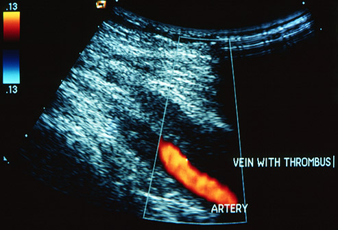 What Are The Early Signs Of Deep Vein Thrombosis (DVT)
