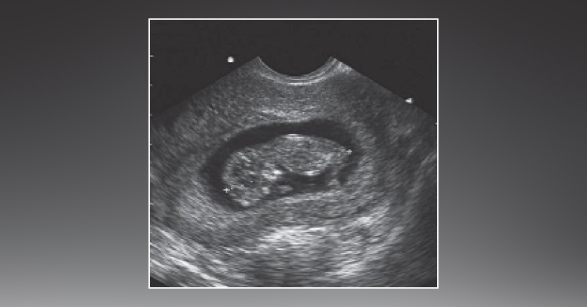 19 And Pregnant