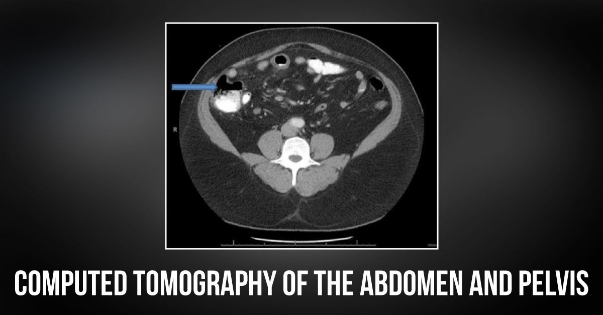 A Rare Case of Periumbilical Abdominal Pain in an Adult