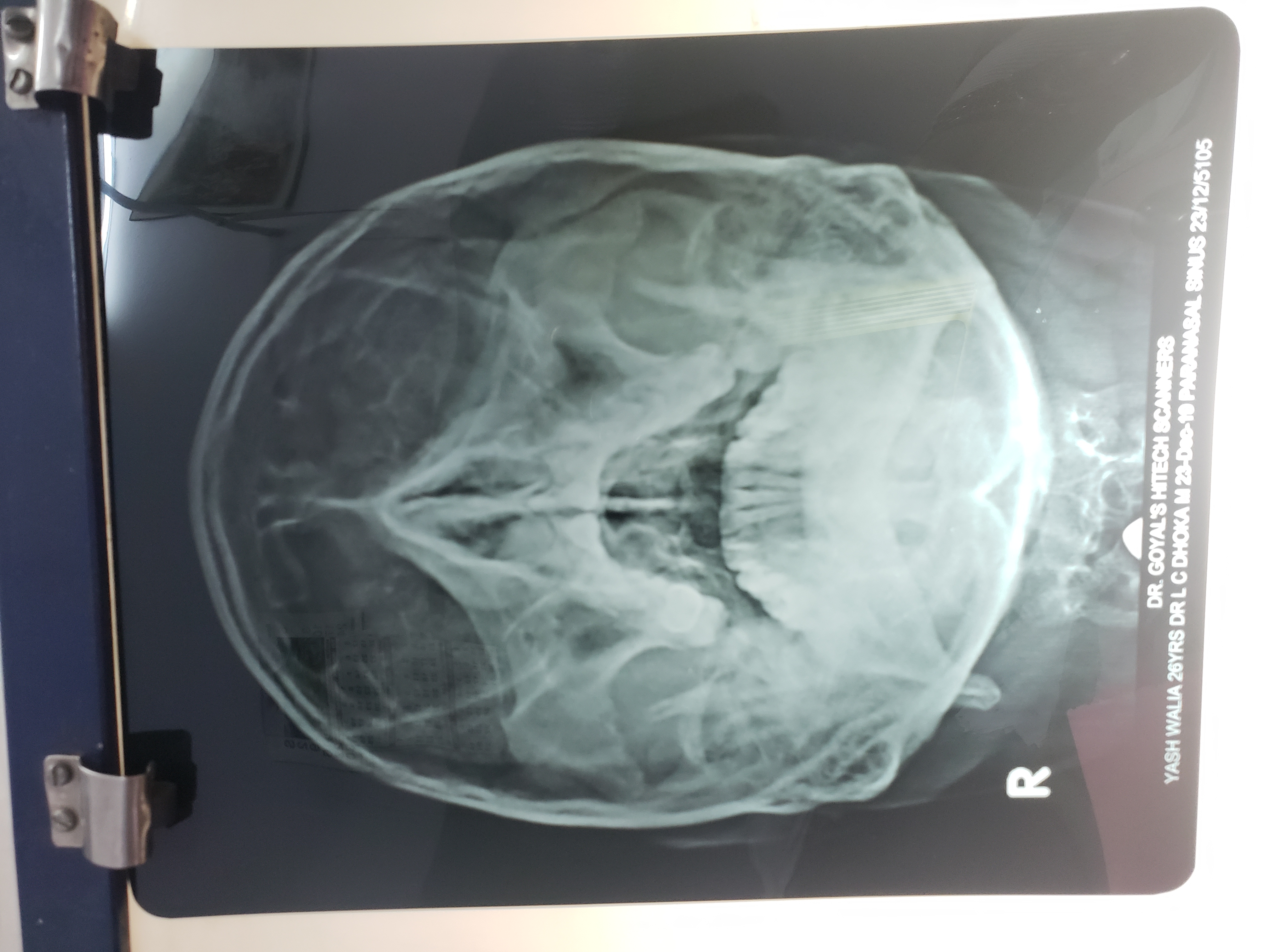 What Is This X-ray: PNS Water's View, Where Are Frontal Sinuses?