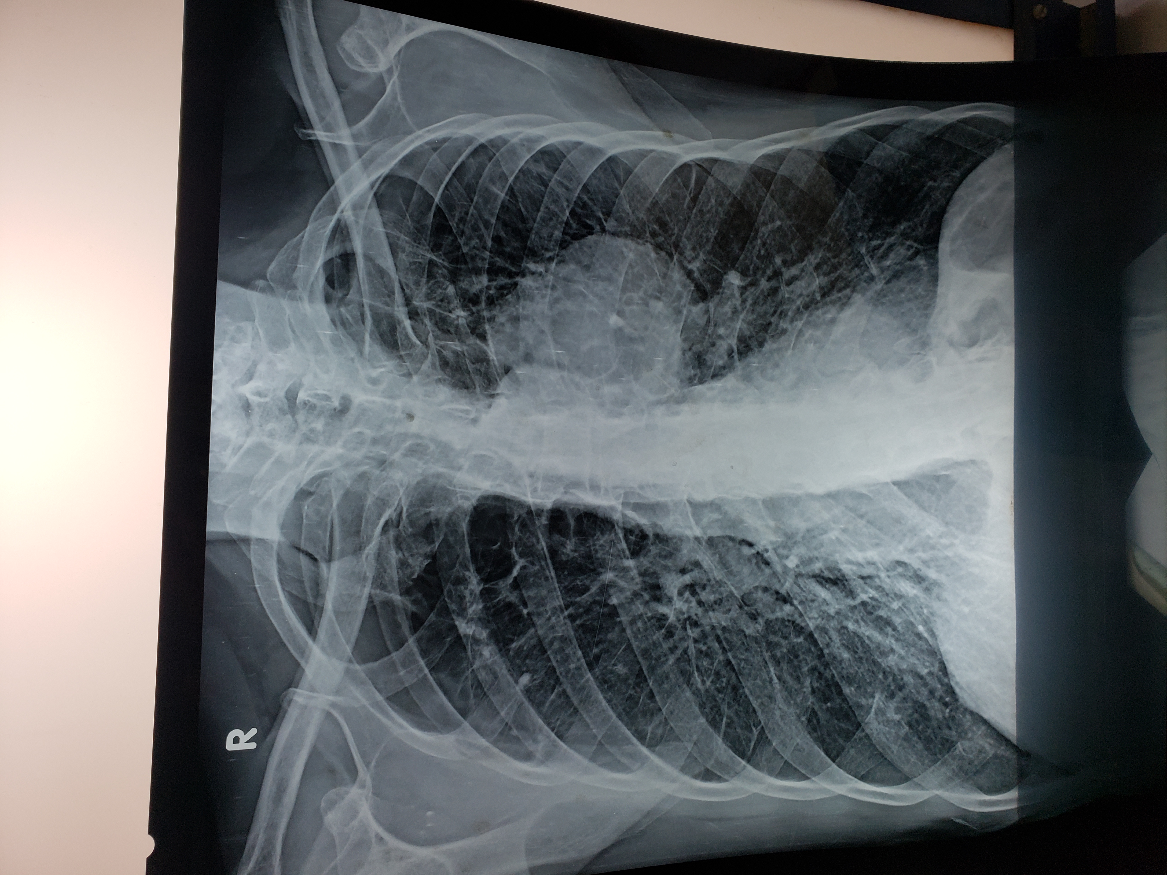 Interpret The Diseases Found In This Chest X Ray