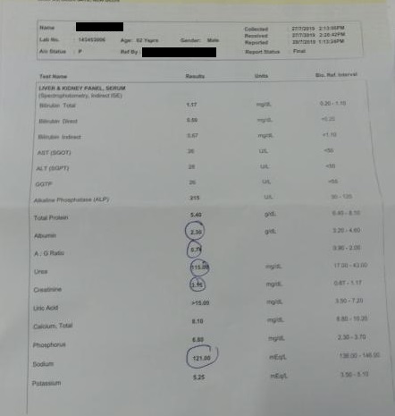 Case Of ANCA Vasculitis With CKD5 Successfully Recovered With OPD Management