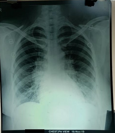 What Is The Cause Of PUO?