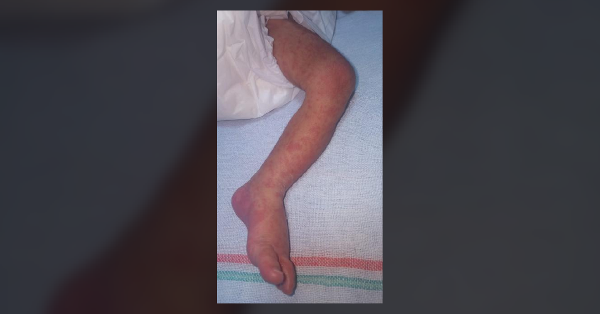 Rash On 6 days old Infant