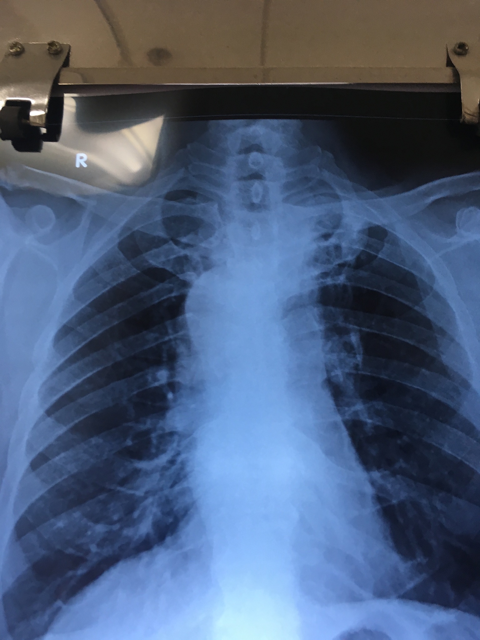 Kommerell Diverticulum- Incidental Diagnosis