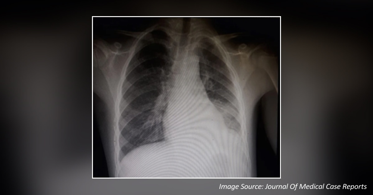 Diagnose This Complication of Pleural Effusion in a Boy