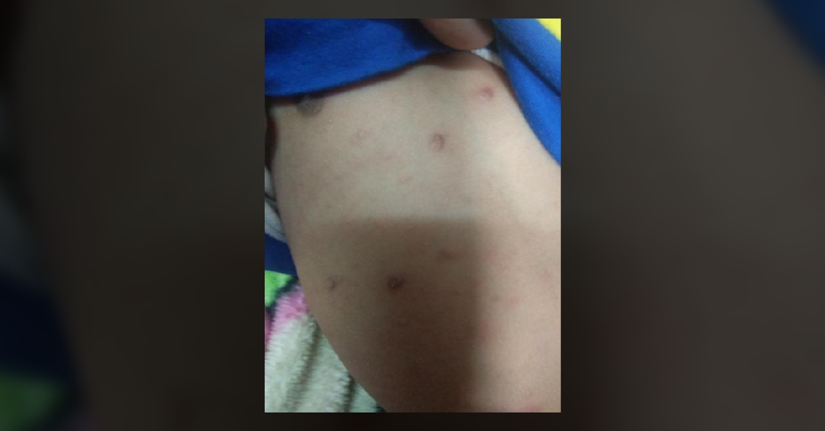 Skin Lesions