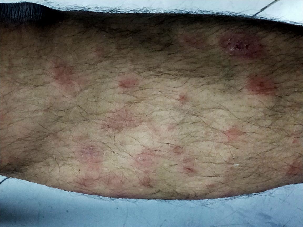 Skin Lesions In A Diabetic Patient 
