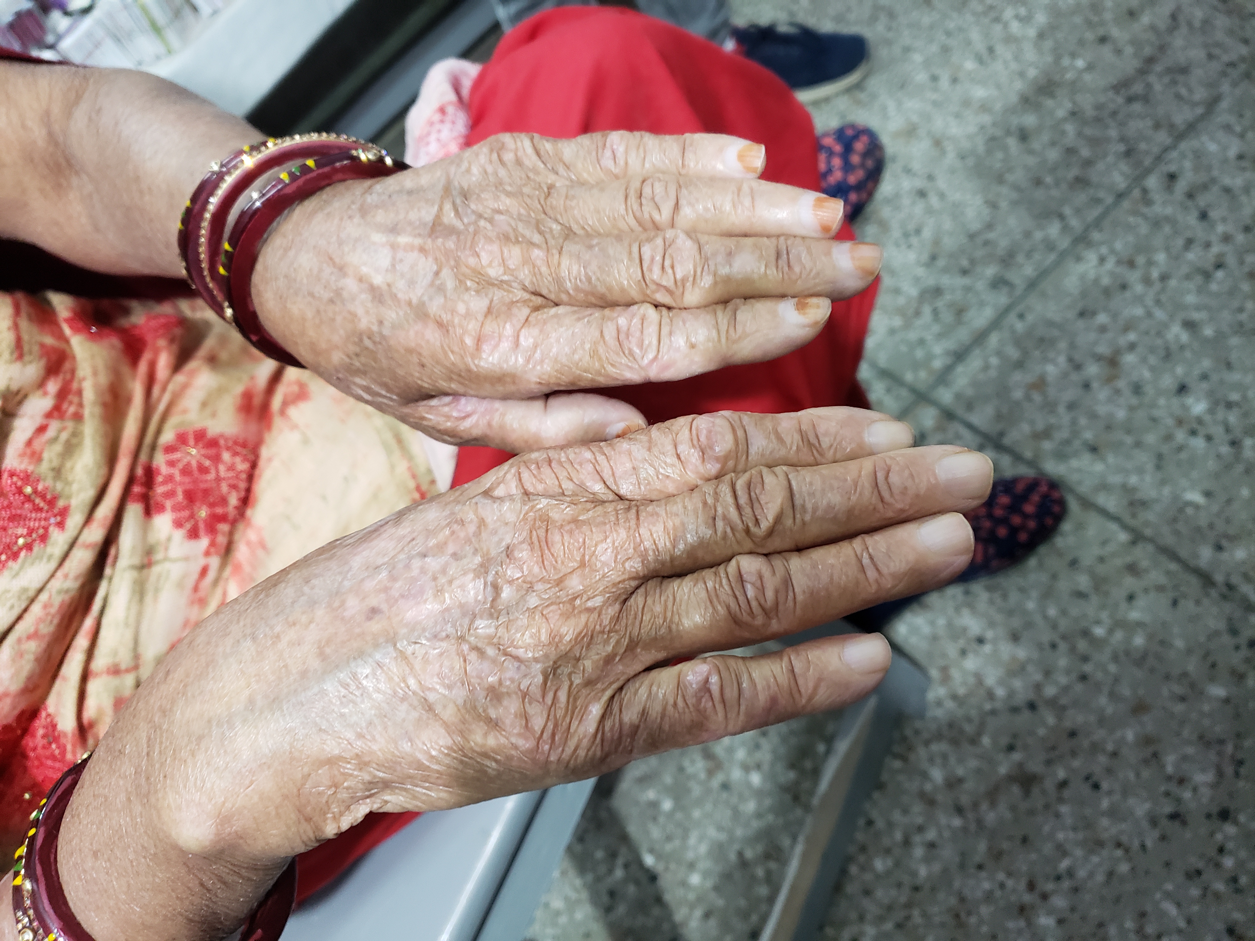 What Happened To Her Hands And Feet?