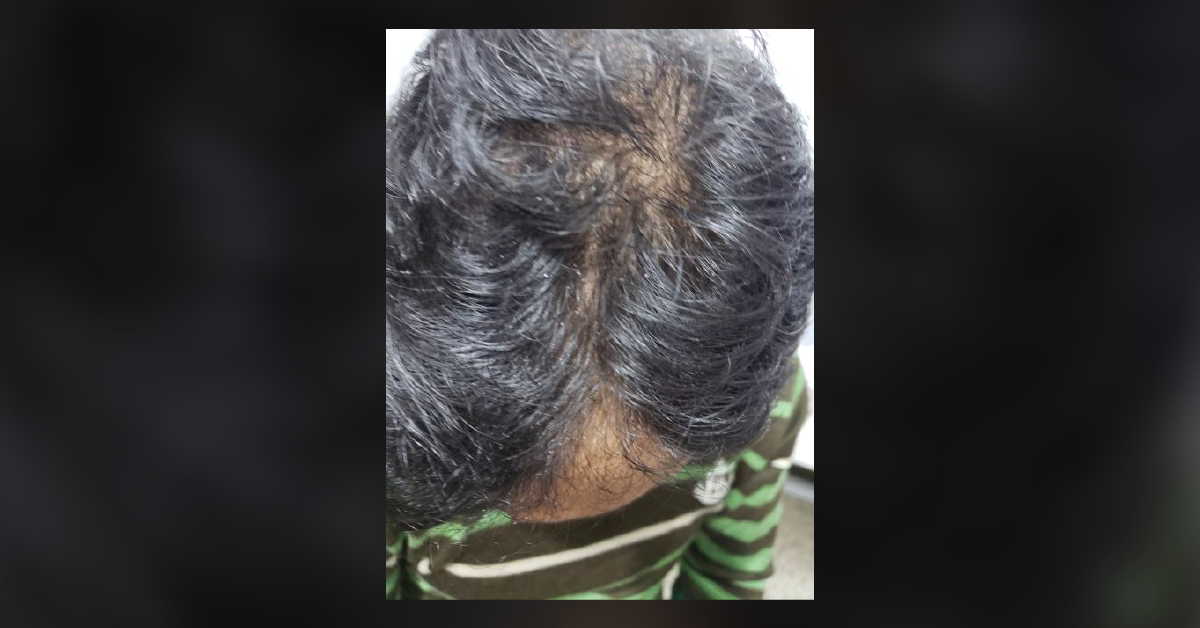 Is It Dandruff Only Or Lice Infestation Too?